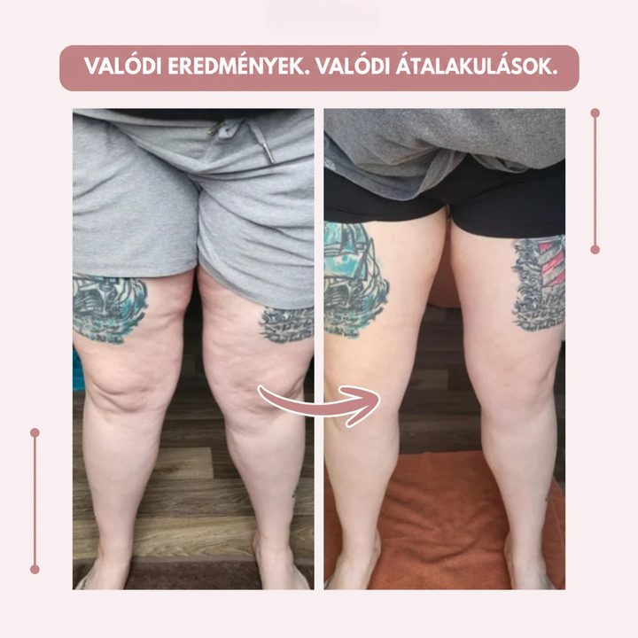 Előtte-utána összehasonlítás elölnézetből: tetovált combú nő szürke, majd fekete rövidnadrágban, jobb oldalon simább lábkép. 18