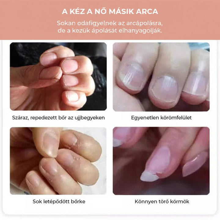 Négy közeli kép száraz, berepedezett körömágyról, érdes körömfelületről, szárnyas bőrről és könnyen törő körmökről 3