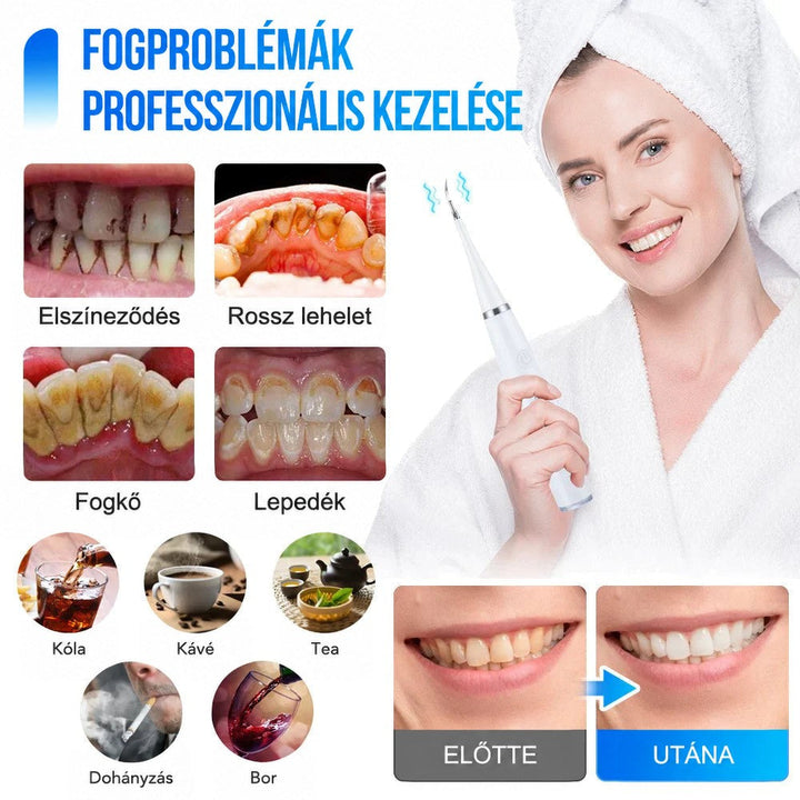 Fehér ultrahangos fogkőeltávolítót tartó mosolygó nő, mellette fogkő, lepedék és elszíneződés példái, valamint előtte-utána összehasonlítás. 2